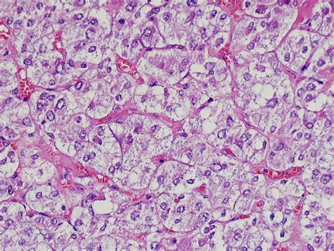 Congenital Adrenal Hyperplasia Histology