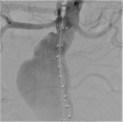 Endovascular Aortic Repair With The Step By Step” Deployment Of The