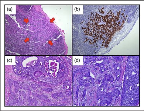 Histopathological Examination Of Sentinel Lymph Node And Right Breast Download Scientific