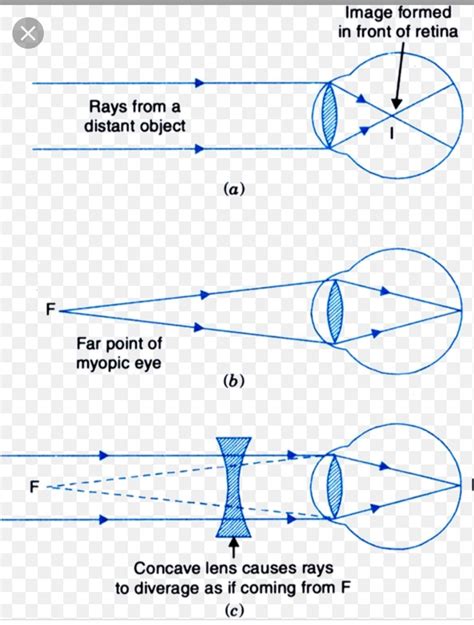 Myopia Ray Diagram