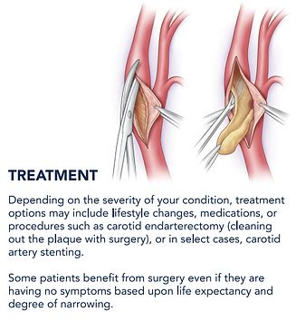 Carotid Artery Disease | Omni Vascular