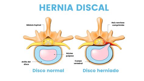 Dolor En La Espalda A Causa De Las Hernias Discales