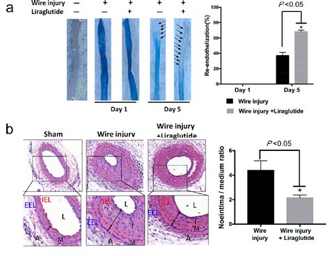 Figure 1 From Liraglutide Inhibits Endothelial To Mesenchymal Transition And Attenuates