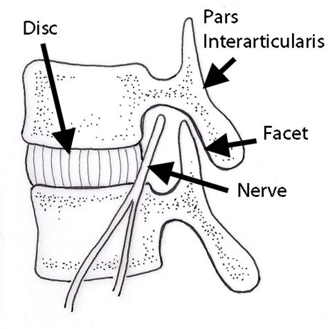 Spondylolysis in Children | Pars Interarticularis Fracture | Vail ...