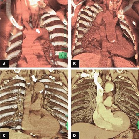 Torsion And Calcification A Arrowhead Of The Abdominal Aorta As