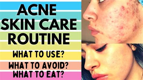 Skincare Routine For Acne How To Get Rid Of Acne Pimples Khatam Karne