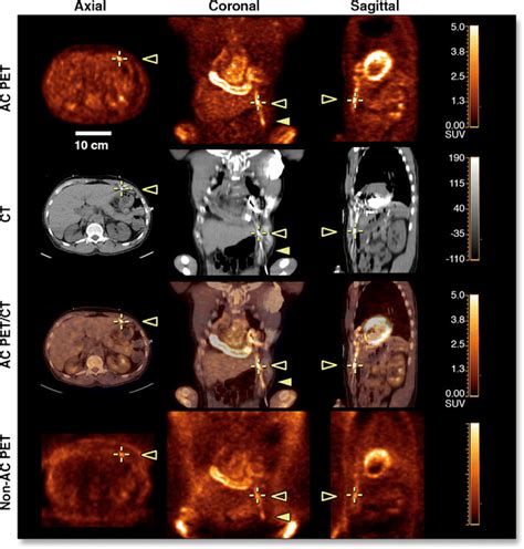 Value Of Fdg Pet Ct In Left Ventricular Assist Device Lvad Infection