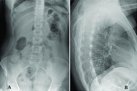 Plain Radiography Of Thoraco Lumbar Spine From Anterior Posterior A