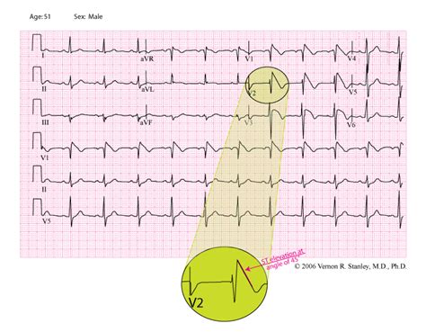 A STEMI Mimic The Brugada Syndrome ECGcourse