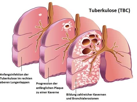 Pleuritis Symptome Pneumonie Pleuraerguss Bronchitis Dauer Ursachen