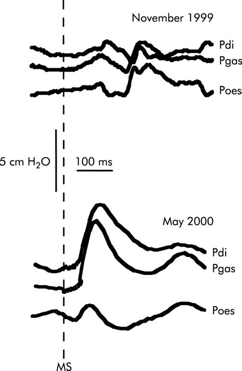 The Pulmonary Physician In Critical Care Illustrative Case 4