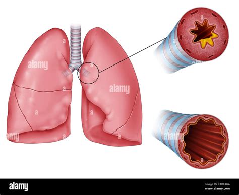 La inflamación de las vías respiratorias pulmonares comparativa de