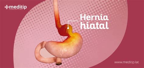 Hernia Hiatal Tipos Causas S Ntomas Y Tratamiento