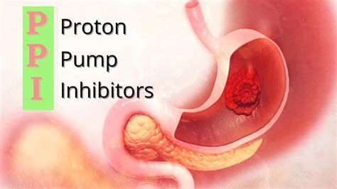 Proton Pump Inhibitors List of PPI Drugs and Side Effects â Medical Hex