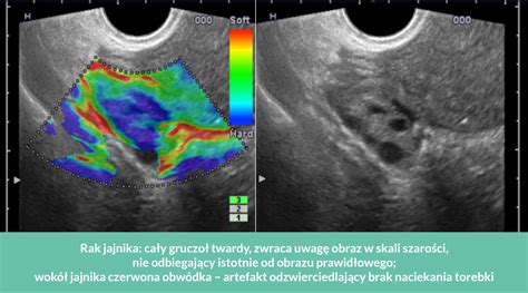 ELASTOGRAFIA O CO W TYM CHODZI VitaSC