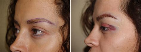 Eyebrow Transplantation Photos Miami FL New York NY Patient 16125