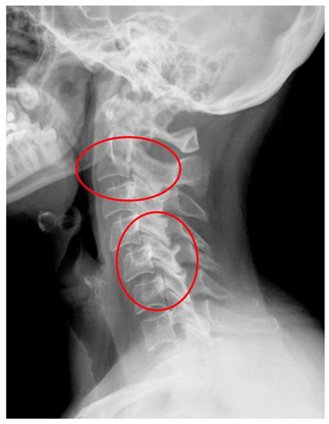 An X-ray of the cervical spine (lateral view) of a 55-year-old female ...