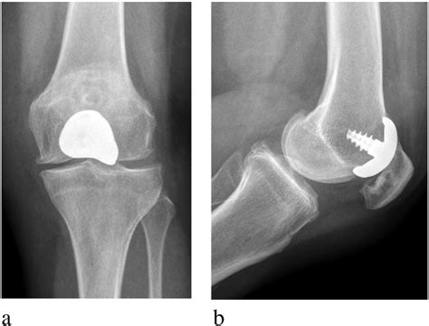 Patellofemoral Arthritis Treated With Resurfacing Implant Clinical