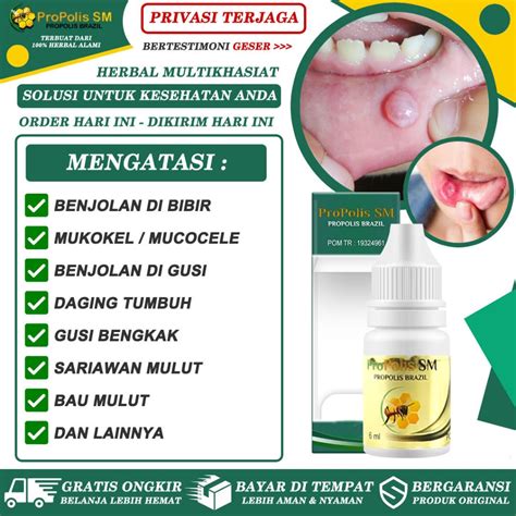 Jual Obat Benjolan Di Bibir Mukokel Mucocele Daging Tumbuh Pada Gusi Bengkak Bernanah Polip