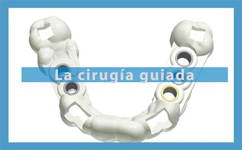 La cirugía guiada para la colocación de implantes dentales en 2021