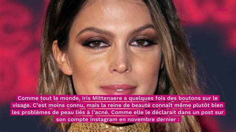 Iris Mittenaere son astuce géniale pour ne pas avoir de boutons