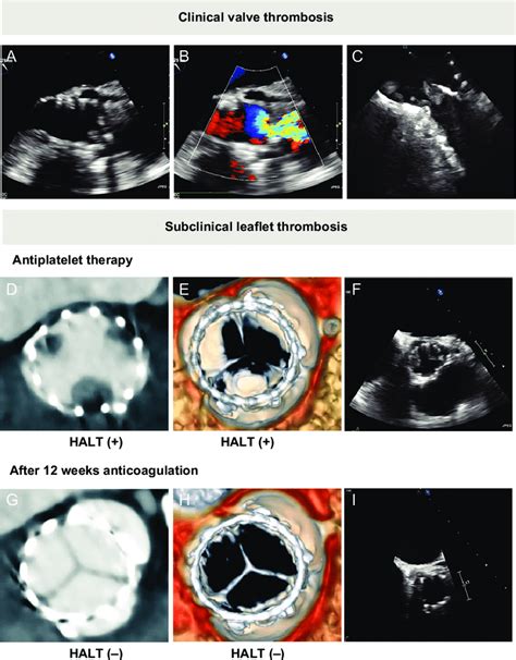 Clinical valve thrombosis and subclinical leaflet thrombosis. (A, B ...