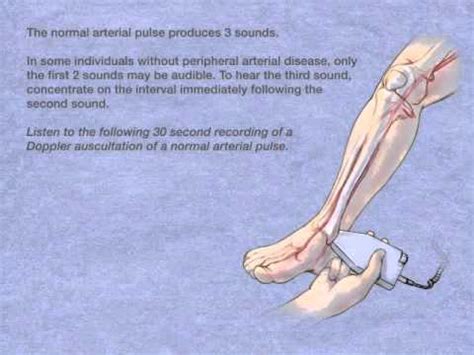 Doppler Auscultation Of The Posterior Tibial Artery Youtube