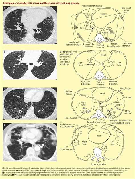 Diffuse Parenchymal Lung Disease Medicine