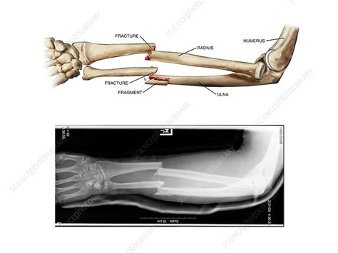 Comminuted Fracture Diagram