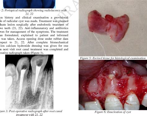 Figure 2 From Surgical Management Of Radicular Cyst With Microscope A