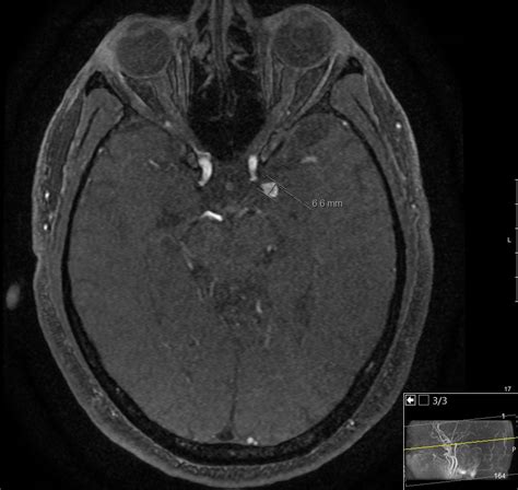 Left Pterional Craniotomy For Ica Aneurysm