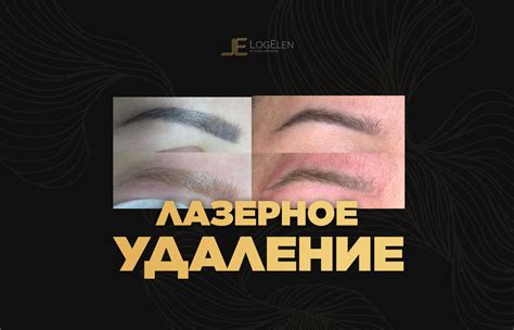 Удаление некачественного татуажа или татуировки