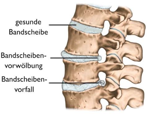 Bandscheibenprotrusion Das Hilft Dir Bei Einer Vorw Lbung Der