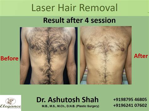 Chest Laser Hair Removal Shop | centralcountiesservices.org