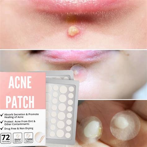 72PCS Waterproof Acne Pimple Patch Anti Acne Serum Acne Removal Gel