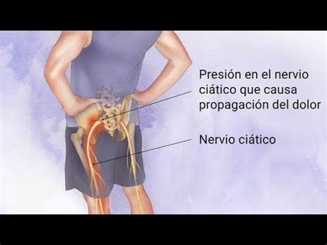 Ci Tica Dolor Lumbar Nervio Ci Tico Causas S Ntomas Diagn Stico Y