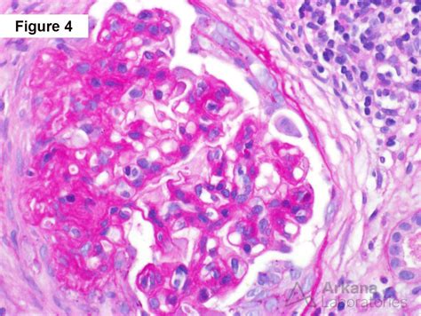 Crescentic Iga Nephropathy Teaching Point Arkana Laboratories