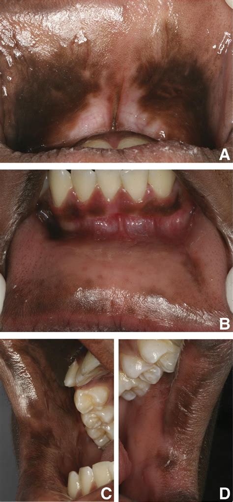 Diffuse Pigmentation Of The Oral Mucosa Oral Surgery Oral Medicine