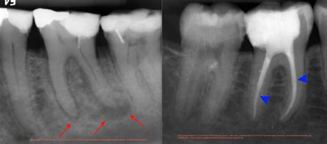 Northbridge Dentists - Root canal