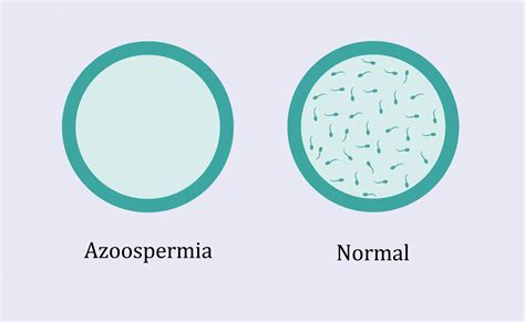 Evaluating And Treating Zero Sperm In Males Azoospermia