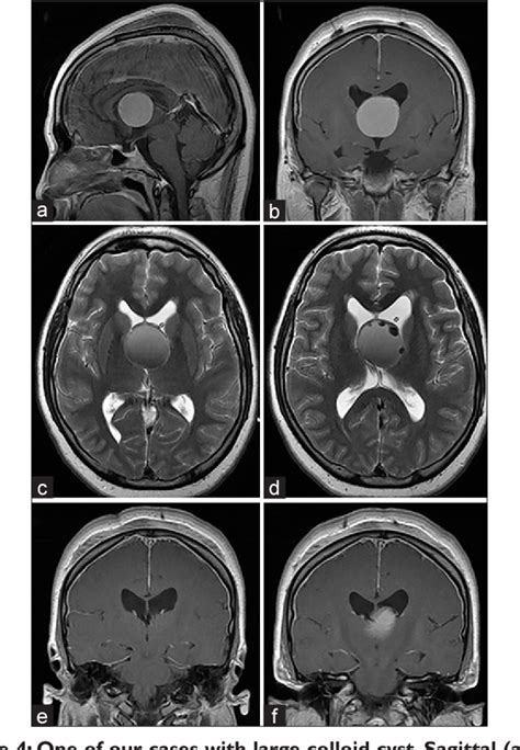 Figure 4 From Colloid Cysts Posterior And Anterior To The Foramen Of Monro Anatomical Features