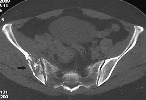 Pelvic Computed Tomography Image Shows A Slightly Expansile