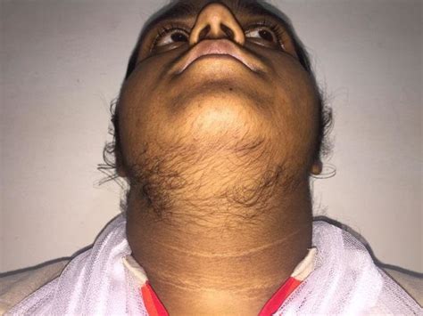 Acanthosis nigricans over the anterior neck in a patient with severe ...