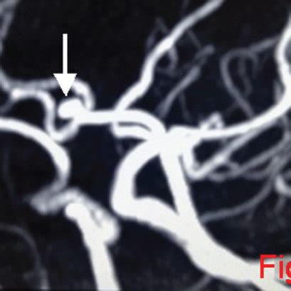 Ac Show The Mra Cta And D Dsa Respectively Of The Anterior