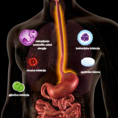 Upale Jednjaka Ezofagitis EKlinika