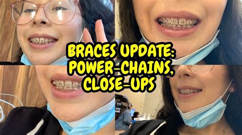 Braces Update Close Ups Adjustment Power Chains Overbite