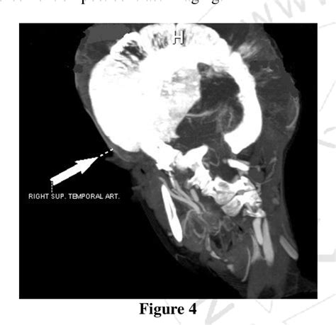 [PDF] Primary Osteosarcoma of the Skull | Semantic Scholar