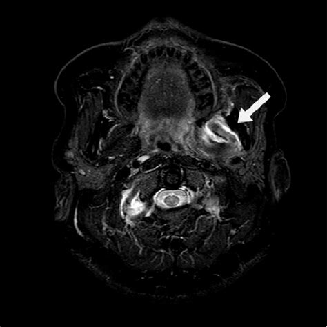 T2-weighted fat saturated STIR MRI (axial section). A non-uniform ...