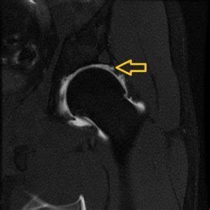 Labral Tears And Fai A Common Cause Of Hip Pain Howard J Luks Md