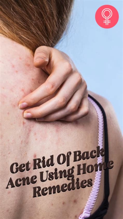 How To Get Rid Of Back Acne Using Home Remedies Artofit